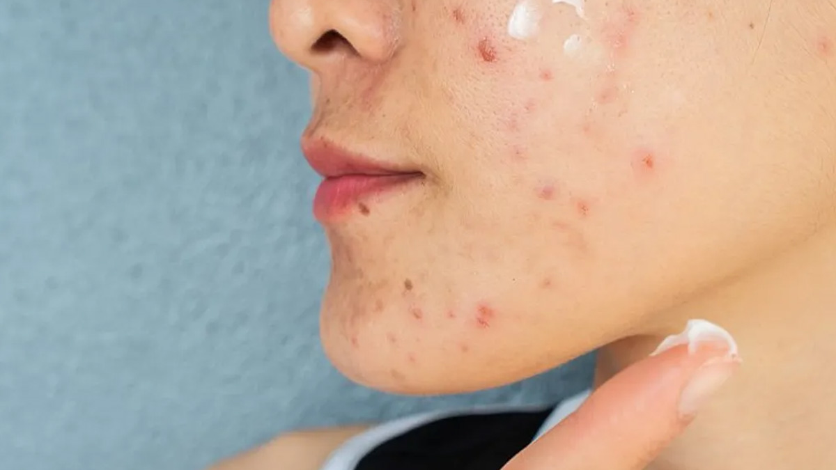 New Study Confirms Cancer Risk In Popular Anti-Acne Products