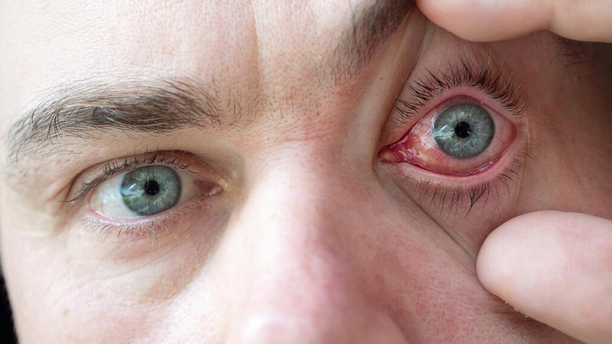 How To Tell If Your Eye Infection Is Contagious: Expert Lists Key Signs And Prevention Tips