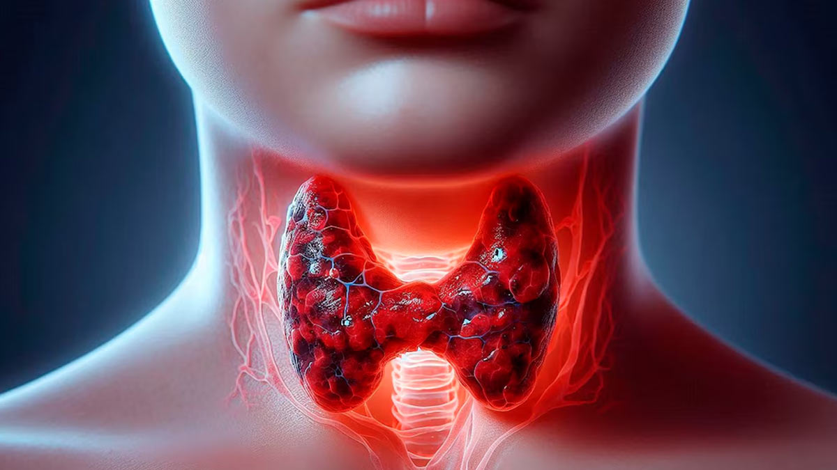 Thyroid Cancer: Understanding Types, Symptoms, And Risk Factors