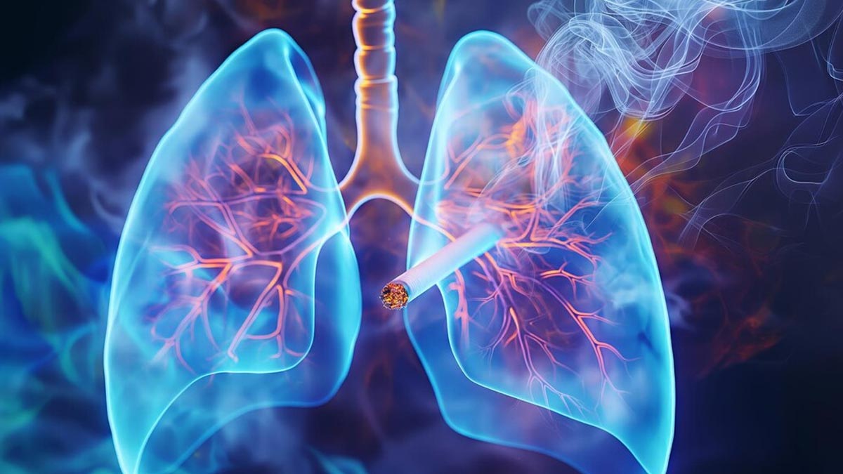 Lung Cancer in Non-Smokers: Exploring the Rising Incidence and Possible Causes